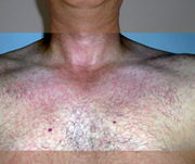 Hautausschlag bei Zika-Infektion ©Fotos: wikipedia